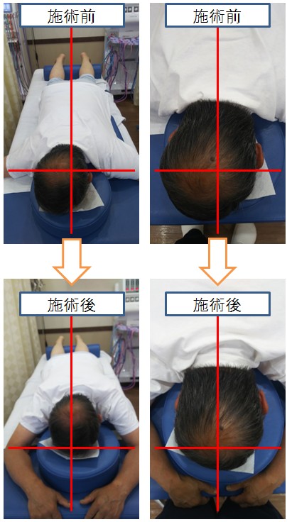 頭蓋骨矯正のビフォアアフター